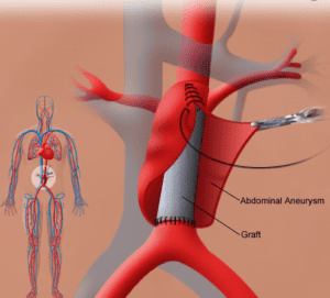 Diagnosis and Treatment Abdominal Aortic Aneurysm
