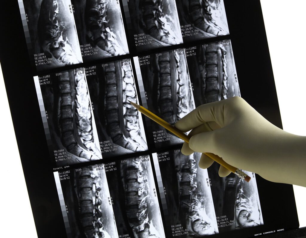 Pop Quiz: Osteoporosis Can Sneak Up on You. Are You at Risk?