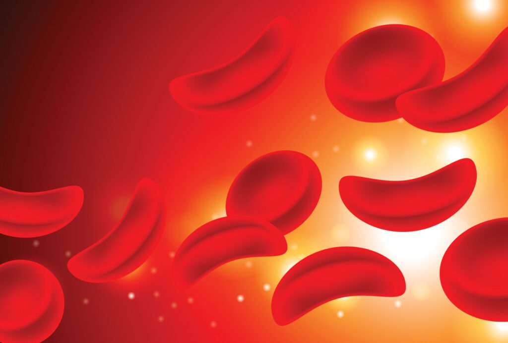 Let’s Talk About Sickle Cell Disease