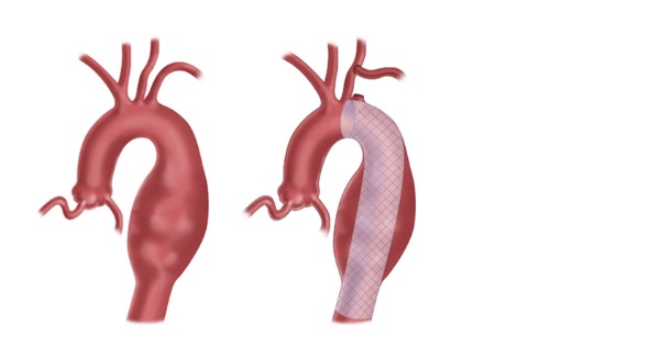 3 Options for Thoracic Aortic Aneurysm Management
