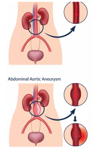 Understanding Abdominal Aortic Aneurysm