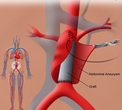 Abdominal Aortic Aneurysm: Diagnosis and Treatment