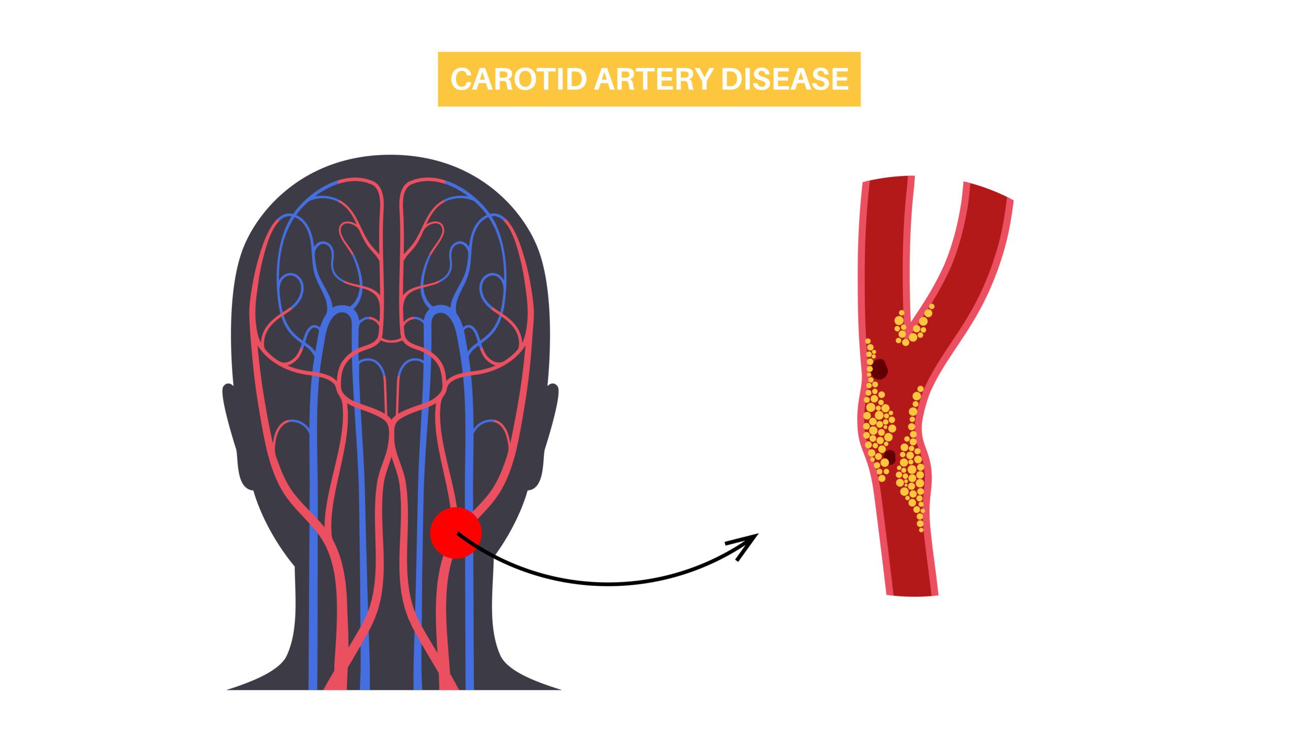 Medical Management and Treatment of Carotid Stenosis