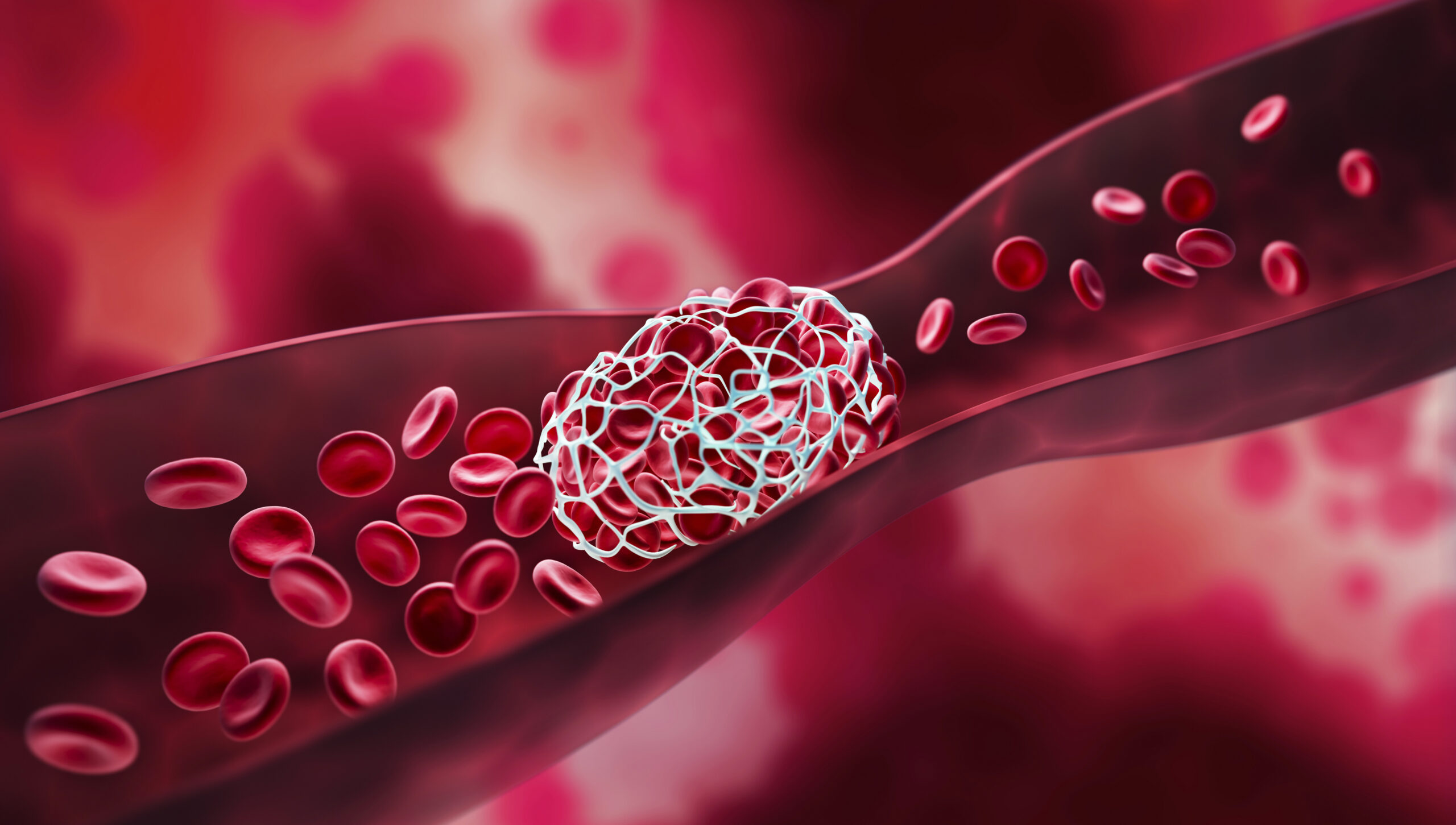 Deep Venous Thrombosis? You’ve Got Treatment Options