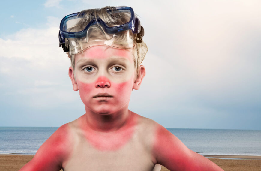 From Sunburn to Heat Rash, Watson Clinic Dermatologist Troubleshoots Summer Skin Problems