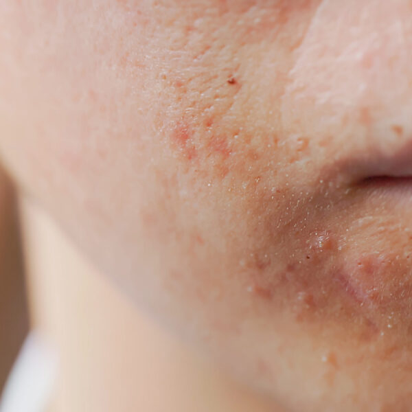 Pop Quiz! Is It Your Skin, or Is It Hormones?